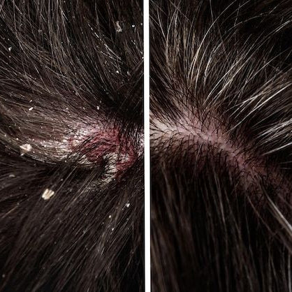 Close-up of scalp with dandruff before and after treatment.